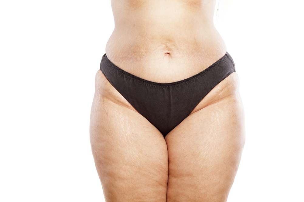 HGH Injection, cellulite, cellulite improved