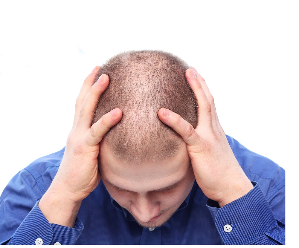 Hair loss, Hormone can Help with Hair Loss
